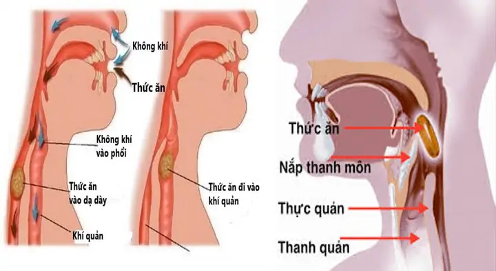Những Bệnh Lý Tiềm Ẩn Đường Tiêu Hóa Và Thần Kinh Dẫn Đến Chứng Hay Sặc Những Bệnh Lý Tiềm Ẩn Đường Tiêu Hóa Và Thần Kinh Dẫn Đến Chứng Hay Sặc