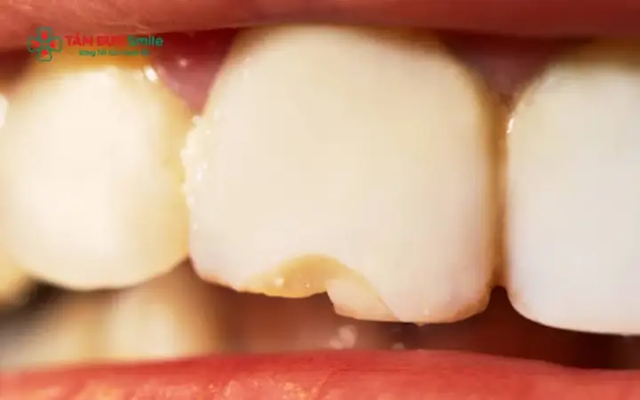 Ê Răng, Mẻ Răng Có Phải Là Điềm Xui Xẻo Hay Mất Mát Tài Lộc Không? Ê Răng, Mẻ Răng Có Phải Là Điềm Xui Xẻo Hay Mất Mát Tài Lộc Không?