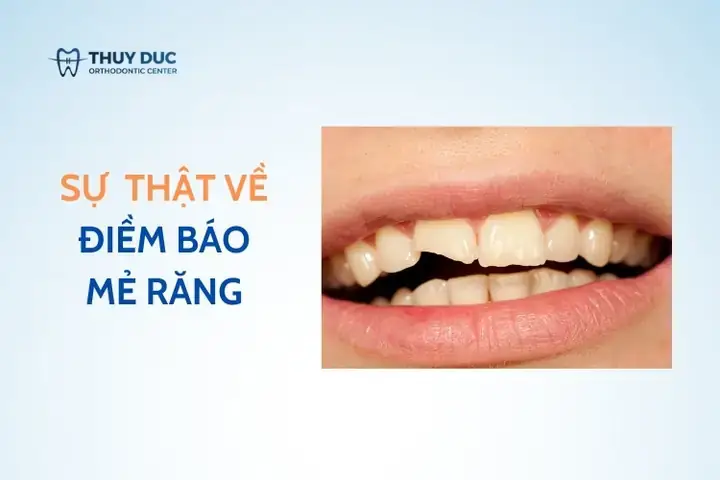Các Phương Pháp Giảm Ê Buốt Răng Tại Nhà An Toàn Các Phương Pháp Giảm Ê Buốt Răng Tại Nhà An Toàn