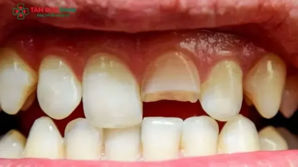 Bị Ê Răng Là Điềm Báo Gì? Giải Mã Tâm Linh Và Góc Nhìn Y Khoa Về Răng Nhạy Cảm