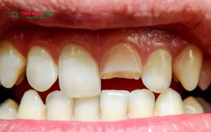 Tình Trạng Mòn Men Răng Và Rối Loạn Khớp Cắn Do Đâu? Tình Trạng Mòn Men Răng Và Rối Loạn Khớp Cắn Do Đâu?
