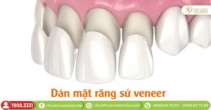 Phương Pháp Trám Răng Và Dán Sứ Veneer Cho Trường Hợp Gãy Nhẹ? Phương Pháp Trám Răng Và Dán Sứ Veneer Cho Trường Hợp Gãy Nhẹ?