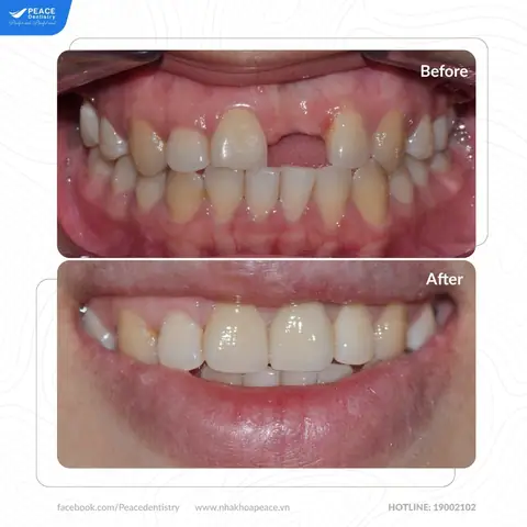 Ảnh Hưởng Đến Khả Năng Ăn Nhai Và Khớp Cắn Ảnh Hưởng Đến Khả Năng Ăn Nhai Và Khớp Cắn