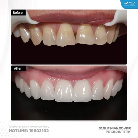 Giải Pháp Bọc Răng Sứ Bảo Vệ Răng Mẻ Nặng Giải Pháp Bọc Răng Sứ Bảo Vệ Răng Mẻ Nặng