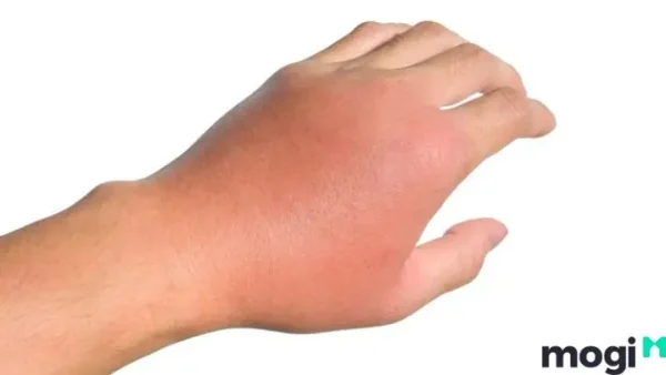 Bị Ong Đốt Đầu Năm Là Điềm Gì? Giải Mã Ý Nghĩa Tài Lộc, Xui Rủi Và Cách Xử Lý