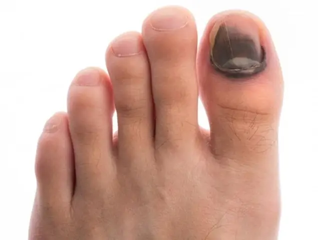 Móng Chân Thay Đổi Hình Dạng Và Màu Sắc Phản Ánh Điều Gì Về Cơ Thể?