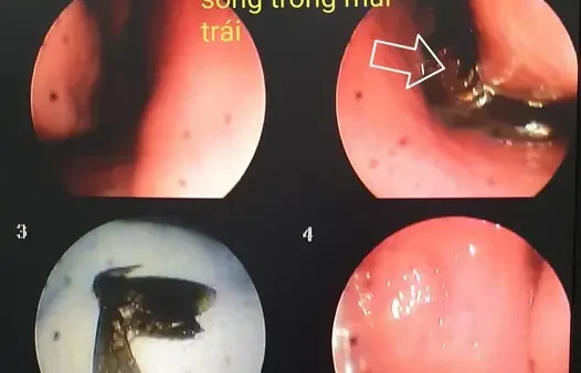 Điềm Báo Muỗi Bay Vào Mũi Là Gì? Giải Mã Ý Nghĩa Phong Thủy Và Cách Xử Lý An Toàn
