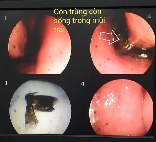 Cần Làm Gì Ngay Khi Bất Ngờ Bị Muỗi Hoặc Côn Trùng Bay Vào Mũi? Cần Làm Gì Ngay Khi Bất Ngờ Bị Muỗi Hoặc Côn Trùng Bay Vào Mũi?