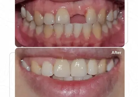 Giải Mã Điềm Báo Răng Vỡ Vụn: Ý Nghĩa Tâm Linh, Góc Nhìn Nha Khoa Và Con Số May Mắn