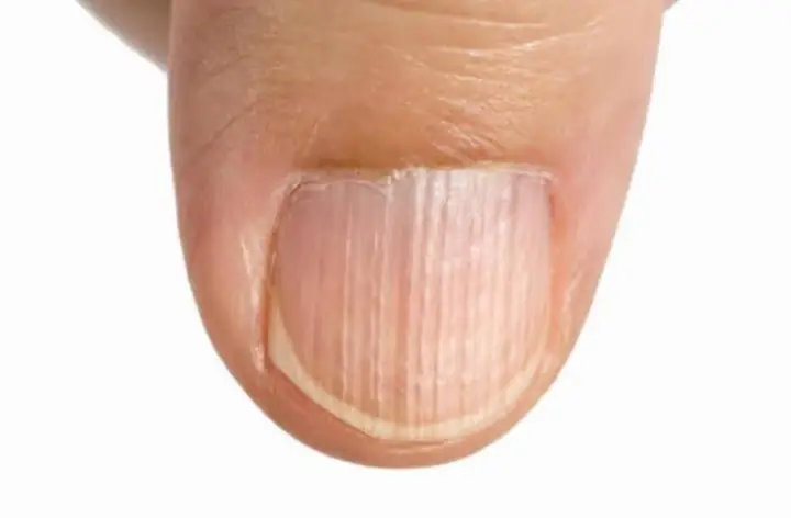 Móng Tay Có Sọc Dọc Màu Trắng Hoặc Đen Cảnh Báo Bệnh Gì? Móng Tay Có Sọc Dọc Màu Trắng Hoặc Đen Cảnh Báo Bệnh Gì?