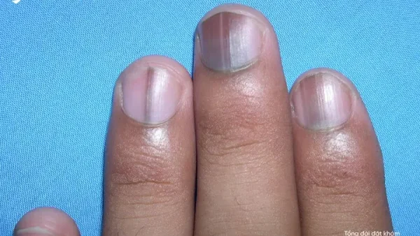 Móng Tay Có Sọc Đen Nhỏ Là Điềm Báo Gì Về Sức Khỏe Hay Ung Thư?