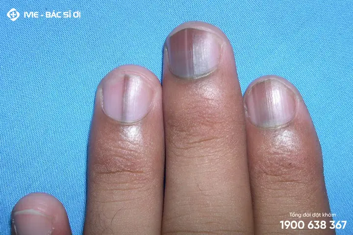 Sai Lầm Thường Gặp Khi Tự Chẩn Đoán Sọc Đen Móng Tay Tại Nhà Sai Lầm Thường Gặp Khi Tự Chẩn Đoán Sọc Đen Móng Tay Tại Nhà