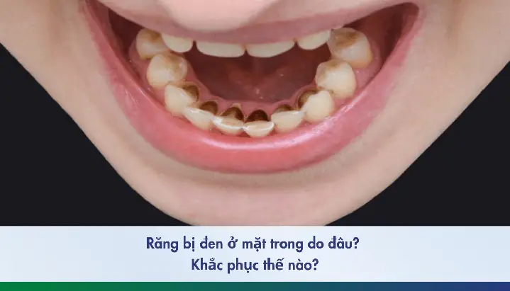 Vết Đen Xuất Hiện Trên Móng Tay Phản Ánh Nhiều Vấn Đề Sức Khỏe Vết Đen Xuất Hiện Trên Móng Tay Phản Ánh Nhiều Vấn Đề Sức Khỏe