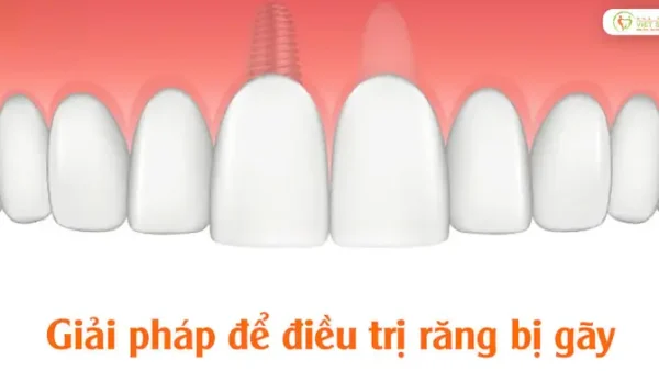 Gãy Răng Điềm Báo Gì? Giải Mã Ý Nghĩa Chi Tiết Theo Khoa Học Và Tâm Linh