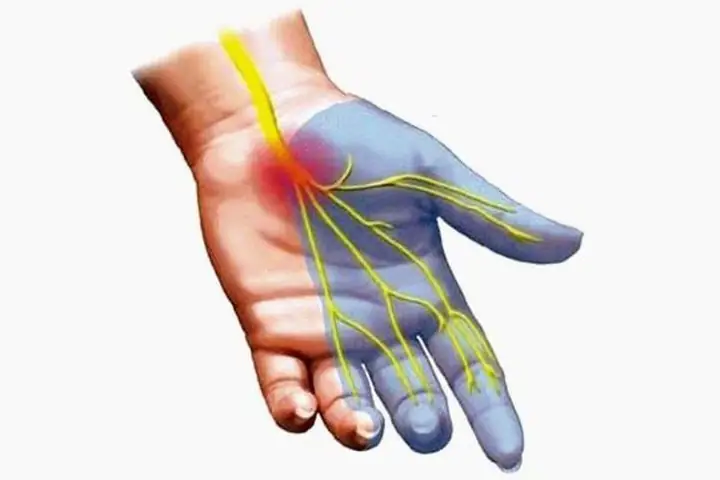 Giải Mã Giấc Mơ Bị Tê Dại Cánh Tay: Ý Nghĩa Điềm Báo Và Nguyên Nhân Sức Khỏe