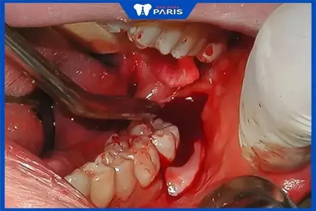 Nằm Mơ Thấy Nhổ 2 Cái Răng Không Chảy Máu Mang Ý Nghĩa Gì?