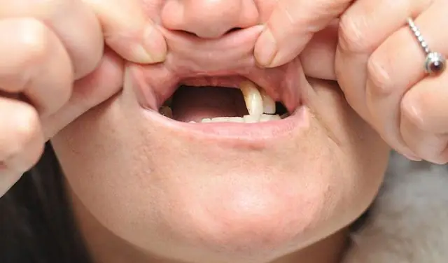 Điềm Báo Khi Mơ Thấy Rụng Răng Cửa Hoặc Răng Hàm Kèm Chảy Máu Điềm Báo Khi Mơ Thấy Rụng Răng Cửa Hoặc Răng Hàm Kèm Chảy Máu