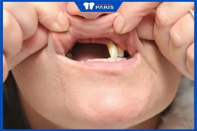 Những Sai Lầm Thường Gặp Khi Quá Lo Lắng Về Điềm Báo Rụng Răng Những Sai Lầm Thường Gặp Khi Quá Lo Lắng Về Điềm Báo Rụng Răng