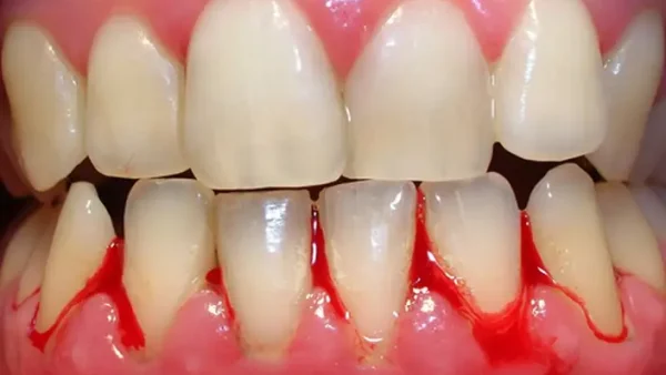 Giải Mã Giấc Mơ Thấy Rụng Răng Cửa Chảy Máu Là Điềm Gì? Tốt Hay Xấu?