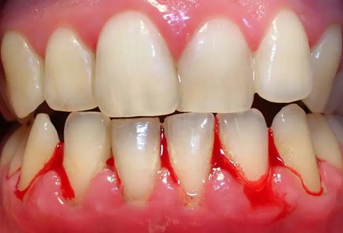 Giấc Mơ Chảy Máu Chân Răng Xuất Phát Từ Đau Nhức Thực Tế Giấc Mơ Chảy Máu Chân Răng Xuất Phát Từ Đau Nhức Thực Tế