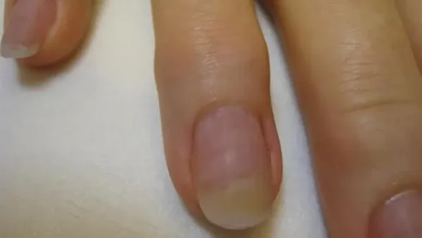 Hạt Gạo Trên Móng Tay Điềm Báo Gì? Giải Mã Ý Nghĩa Tâm Linh Và Y Khoa Chính Xác Nhất