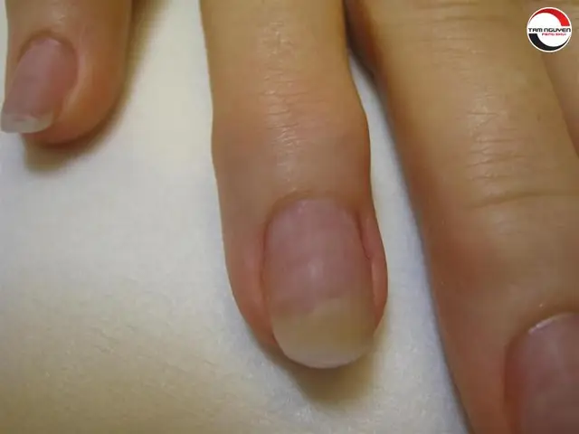 Cách Chăm Sóc Và Phòng Ngừa Đốm Trắng Trên Móng Tay Hiệu Quả Cách Chăm Sóc Và Phòng Ngừa Đốm Trắng Trên Móng Tay Hiệu Quả