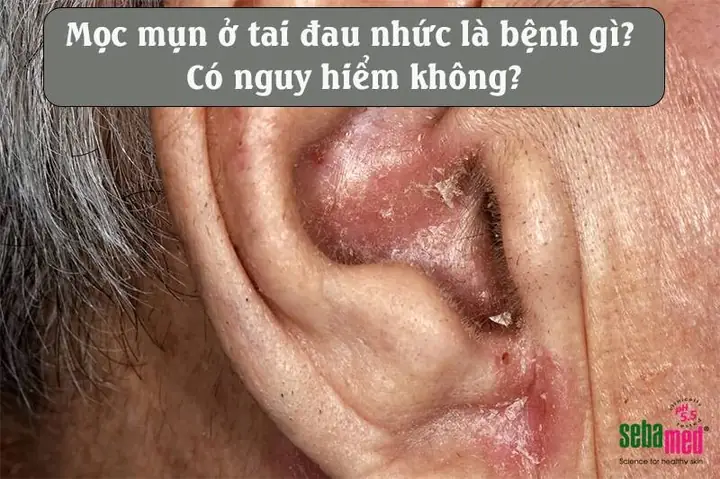 Hình Ảnh Minh Họa Vị Trí Mụn Mọc Ở Tai Gây Đau Nhức