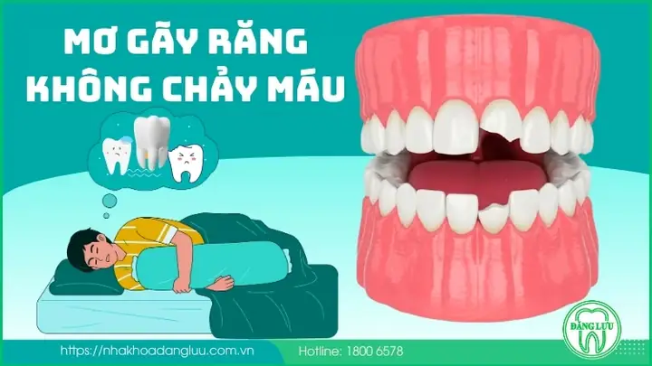 Nằm Mơ Thấy Rụng 1 Cái Răng Nhưng Không Chảy Máu Có Ý Nghĩa Gì? Nằm Mơ Thấy Rụng 1 Cái Răng Nhưng Không Chảy Máu Có Ý Nghĩa Gì?