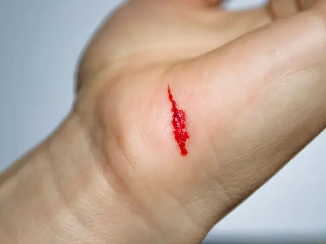 Nằm Mơ Thấy Bị Đứt Tay Hoặc Chảy Máu Cam Mang Ý Nghĩa Gì?