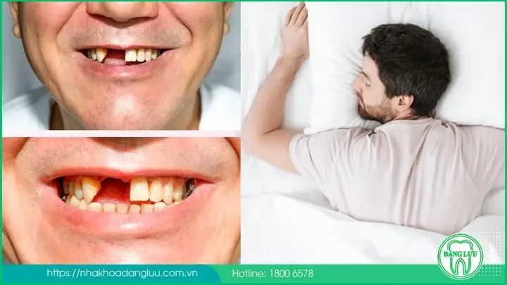 Điềm Báo Từ Giấc Mơ Gãy Răng Cửa Hàm Trên Và Hàm Dưới Điềm Báo Từ Giấc Mơ Gãy Răng Cửa Hàm Trên Và Hàm Dưới