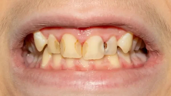 Nằm Mơ Thấy Gãy Răng Cửa Là Điềm Gì? Giải Mã Chi Tiết Ý Nghĩa Tâm Linh Và Tâm Lý