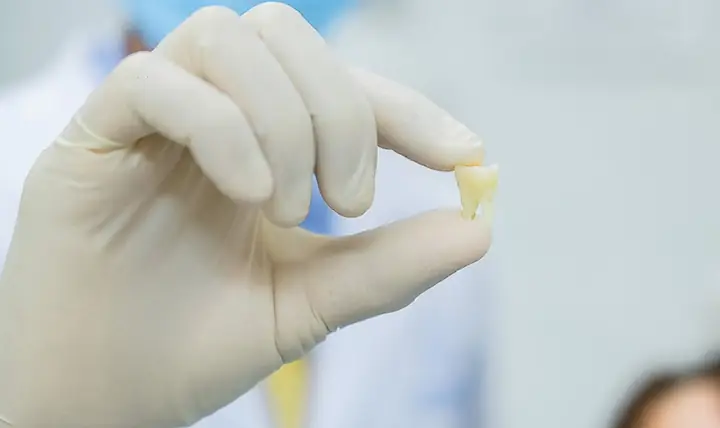 Nằm Mơ Thấy Tự Nhổ Răng Của Mình Nhưng Không Chảy Máu Là Điềm Gì?