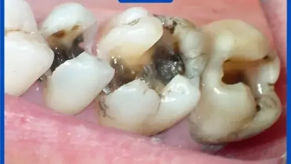 Nằm Mơ Thấy Mình Tự Nhổ Răng Là Điềm Gì? Giải Mã Ý Nghĩa Và Con Số May Mắn