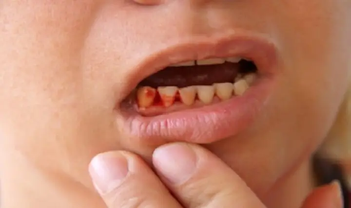 Ngủ Mơ Thấy Mình Tự Nhổ Răng Có Chảy Máu Đánh Con Gì Chuẩn Nhất?