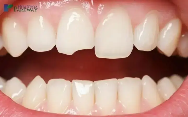 Ý Nghĩa Giấc Mơ Mẻ Răng Theo Vị Trí Cụ Thể