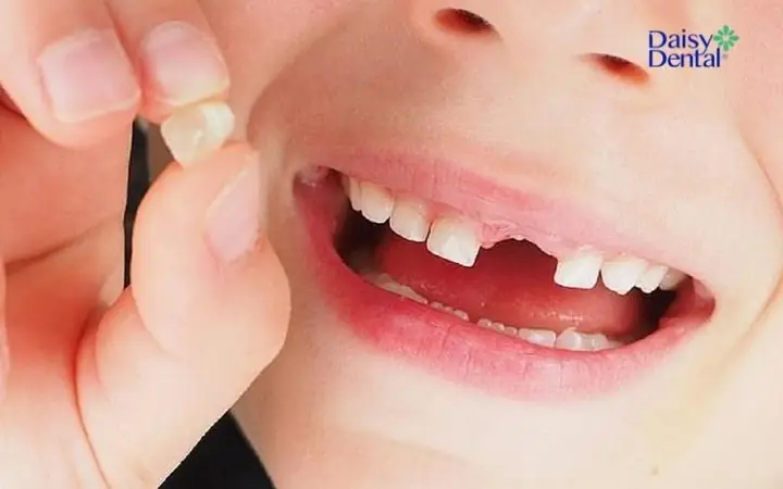 Mơ Thấy Rụng Răng Hàm Trên Không Đau, Không Chảy Máu Điềm Báo Điều Gì? Mơ Thấy Rụng Răng Hàm Trên Không Đau, Không Chảy Máu Điềm Báo Điều Gì?