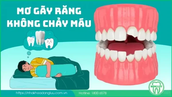 Nằm Mơ Thấy Rụng Răng Hàm Trên Là Điềm Gì, Đánh Con Gì Trúng Lớn?