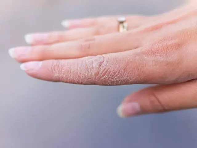 Cách Giữ Ẩm Và Chăm Sóc Da Tay Bị Kích Ứng Tại Nhà Cách Giữ Ẩm Và Chăm Sóc Da Tay Bị Kích Ứng Tại Nhà
