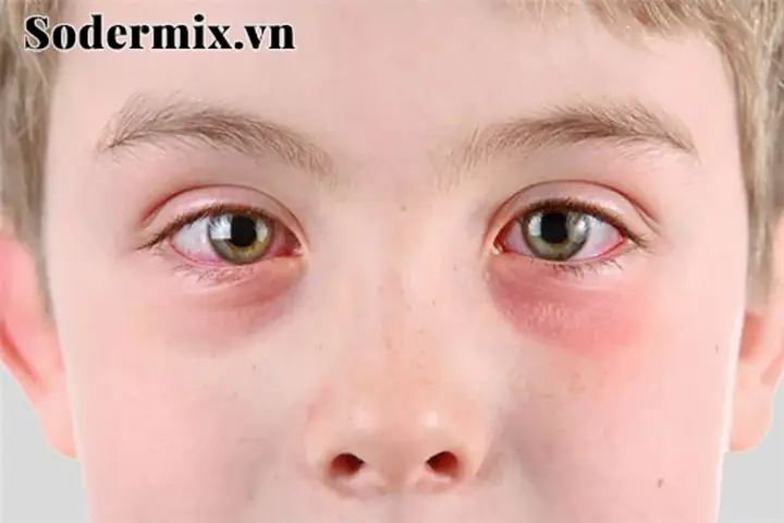 Ngứa Mắt Trái Là Điềm Báo Gì Theo Quan Niệm Dân Gian Và Phong Thủy?