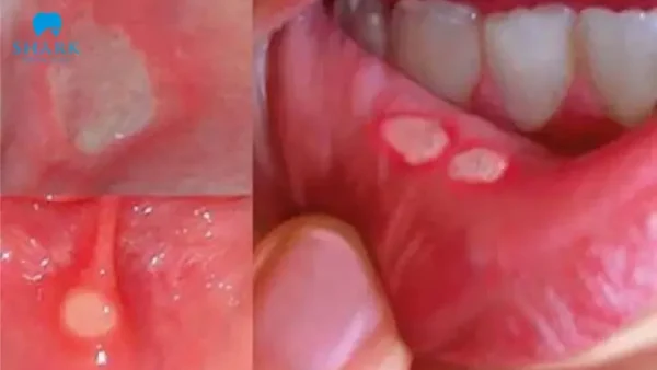 Răng Cắn Vào Má Trong Là Điềm Gì? Nguyên Nhân Thực Tế Và Cách Khắc Phục Hiệu Quả