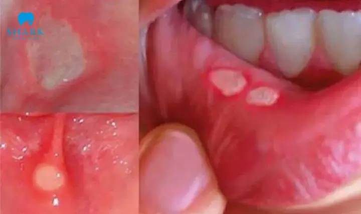 Răng Cắn Vào Má Trong Là Điềm Gì? Nguyên Nhân Thực Tế Và Cách Khắc Phục Hiệu Quả