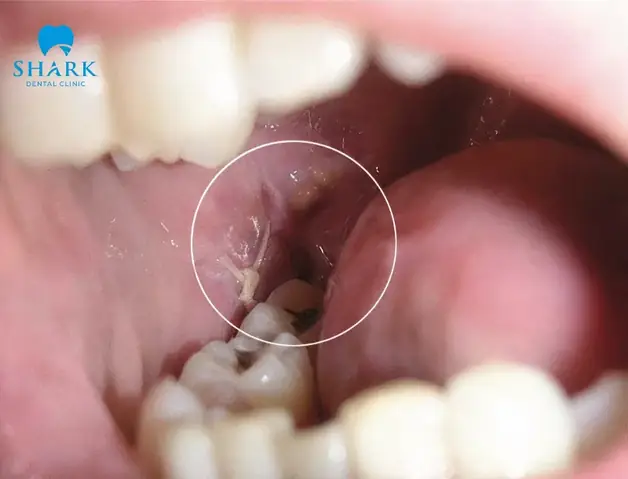 Do Lệch Khớp Cắn Và Cấu Trúc Răng Mọc Sai Vị Trí