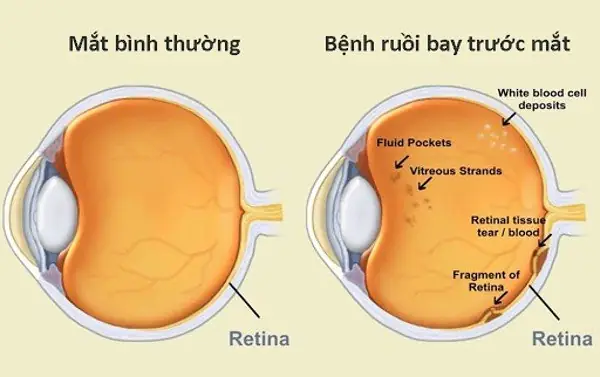 Khi Nào Hiện Tượng Ruồi Bay Trước Mắt Trở Nên Nguy Hiểm Cần Đi Khám Bác Sĩ? Khi Nào Hiện Tượng Ruồi Bay Trước Mắt Trở Nên Nguy Hiểm Cần Đi Khám Bác Sĩ?
