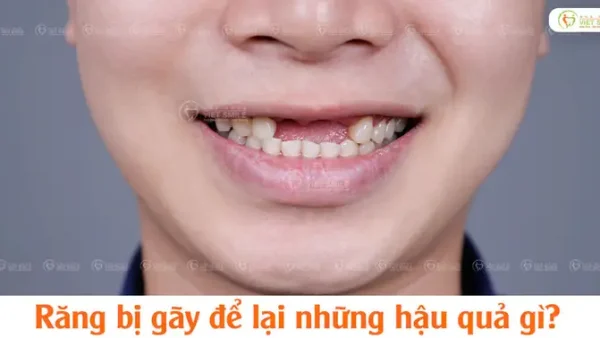 Tự Nhiên Bị Gãy Răng Có Điềm Gì? Giải Mã Ý Nghĩa Tâm Linh Và Góc Nhìn Khoa Học
