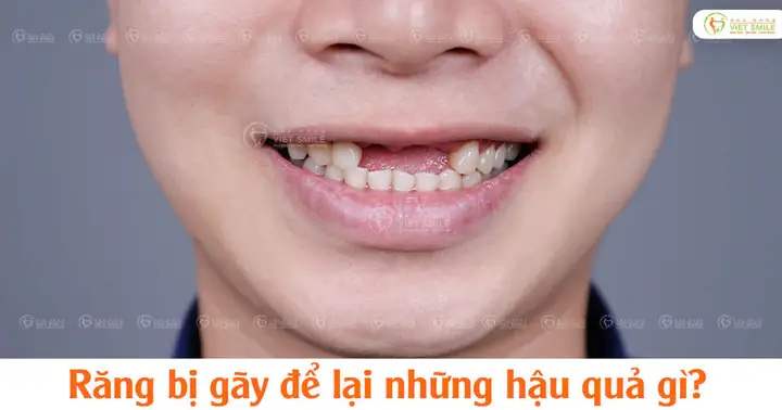 Minh Họa Tình Trạng Răng Bị Gãy Ngang Làm Lộ Ngà Răng Và Tủy Minh Họa Tình Trạng Răng Bị Gãy Ngang Làm Lộ Ngà Răng Và Tủy