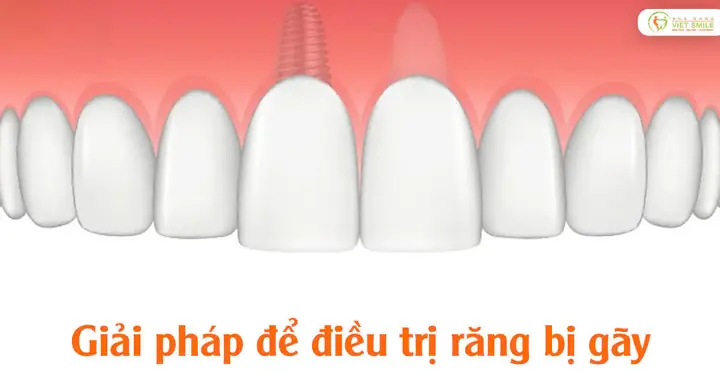 Các Giải Pháp Điều Trị Hiệu Quả Khi Răng Bị Gãy Là Gì? Các Giải Pháp Điều Trị Hiệu Quả Khi Răng Bị Gãy Là Gì?