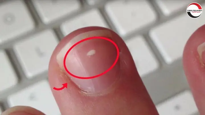 Xem Bói Điềm Trắng Trên Móng Tay: Ý Nghĩa Dân Gian Và Góc Nhìn Khoa Học Xem Bói Điềm Trắng Trên Móng Tay: Ý Nghĩa Dân Gian Và Góc Nhìn Khoa Học